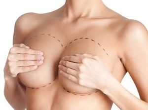 Збільшення грудей імплантами